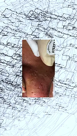 #pimpleremover #pimples #fypage #pimple #acne #satisfyingvideo #pimpleremover2k24 #