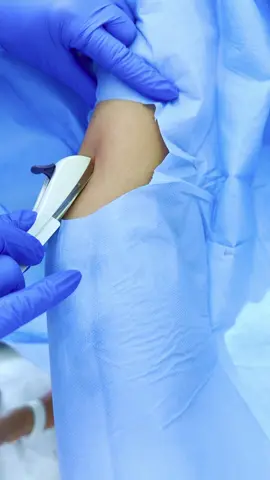 🔹 Implanon: método seguro e eficaz! 🔹 Hoje, mostramos a colocação do Implanon, um implante contraceptivo subdérmico ideal para quem busca proteção de longa duração. Essa jovem de 16 anos optou por esse método para evitar gestação indesejada e ter mais liberdade. O procedimento é rápido, seguro e indolor, realizado em poucos minutos! Quer saber se é o ideal para você? Agende uma consulta e tire suas dúvidas! 💙 📲 Entre em contato pelo WhatsApp: (12) 99792-0232 📍 Atendimento especializado na @clinica.ladycare #Implanon #Anticoncepcional #ContracepçãoSegura #SaúdeFeminina #Ginecologia #MétodoContraceptivo #Prevenção #SaúdeDaMulher
