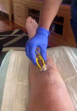 My infected leg ….ouch how much packing do you need. 