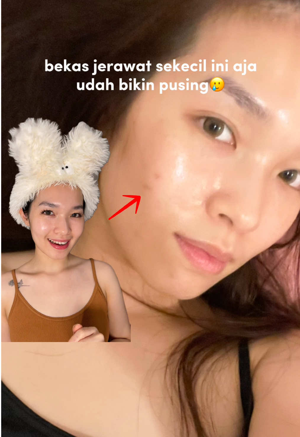BESTTT buat mudarin bekas jerawat👌🏼 pake mositurizer aja cukup, asal rutin