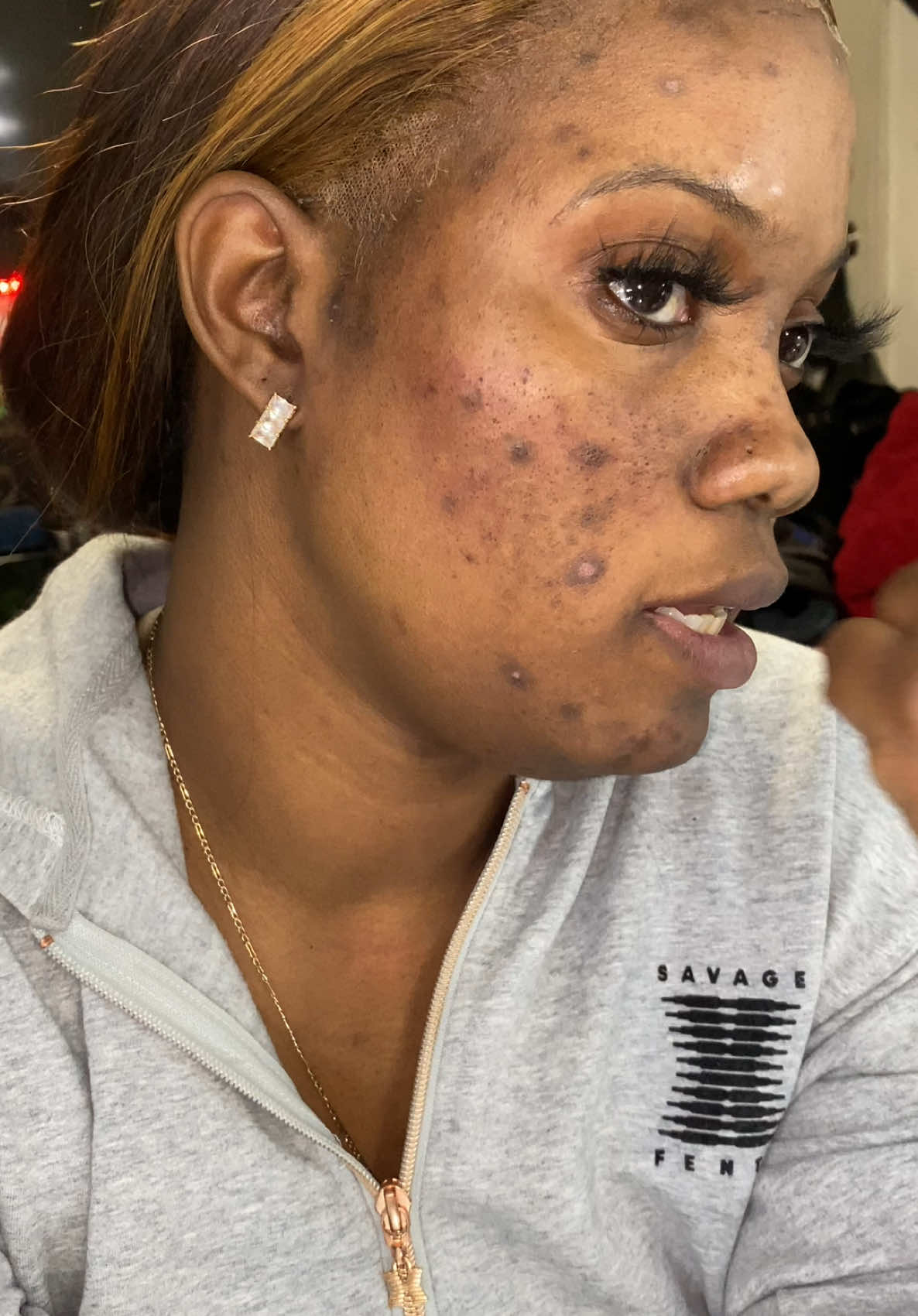 “From Covering Up to Clearing Up ✨ | My Journey with Cystic Acne 🧖‍♀️ For years, I hid behind makeup, struggling with cystic acne and hyperpigmentation that made me feel insecure and isolated. Questions like ‘What’s wrong with your skin?’ haunted me. After 7 years as a makeup artist, I got tired of covering up the problem and decided to treat it. 💪 I followed my dream, went to esthetician school, and learned how to achieve healthy, glowing skin—not just for me, but for others, too. You deserve to feel confident in your own skin. 💕 Let’s talk about healing, not hiding.” #CysticAcne #Hyperpigmentation #SkinCareJourney #FromHidingToHealing #ClearSkinGoals #EstheticianLife #AcneAwareness #SkinCareTips #GlowingSkin #ConfidenceBoost #MakeupToSkinCare #HealthySkinMatters #SkinTransformation #BeautyJourney #skincaremotivation 