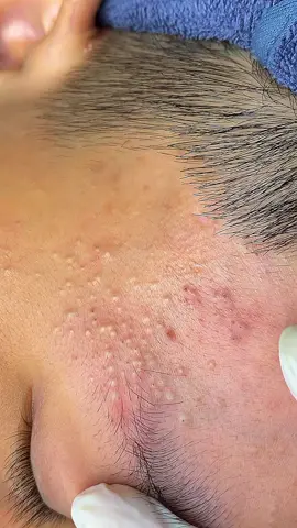 #creatorsearchinsights #satisfyingvideo #pimplepopper #pimple 