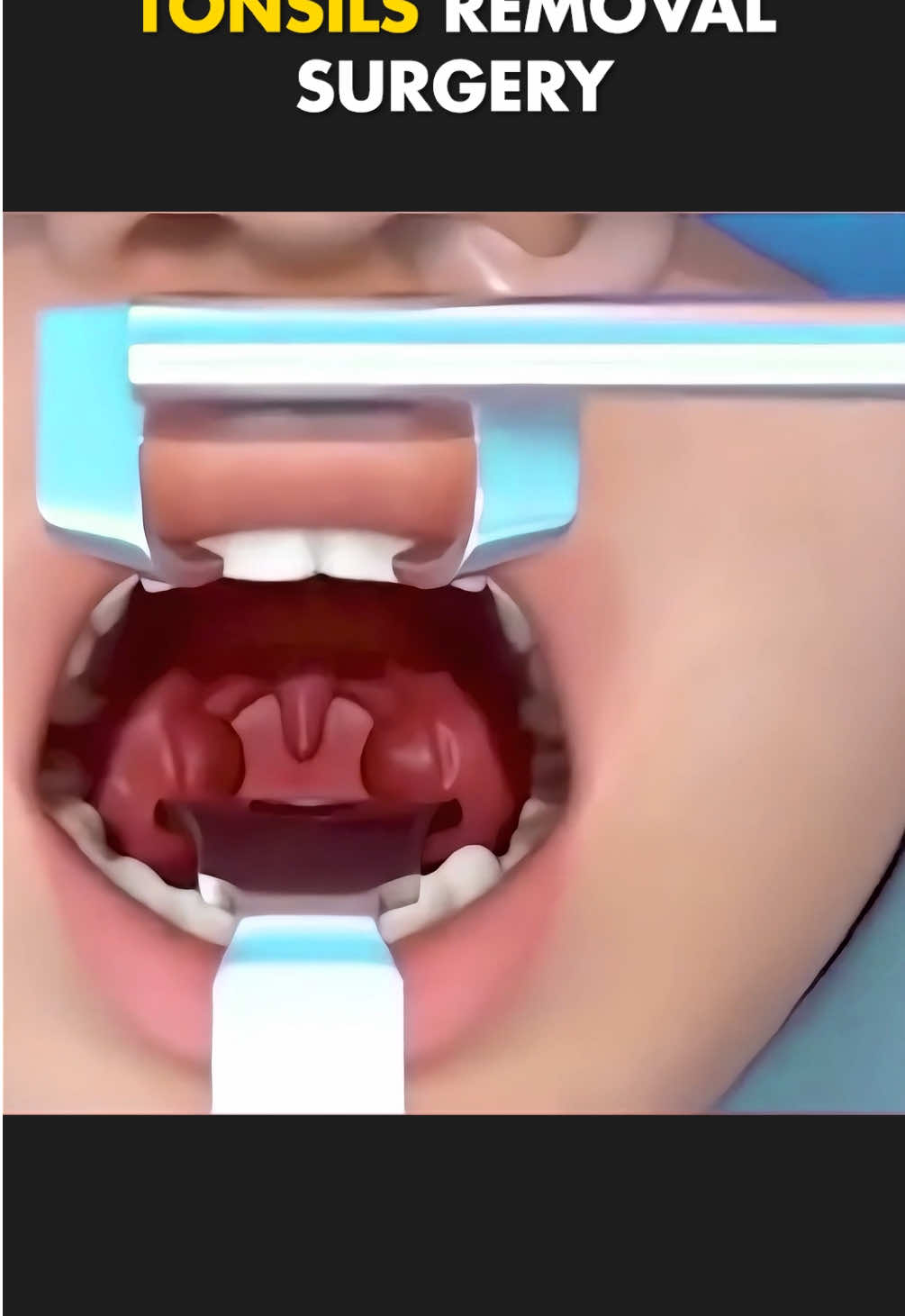 Tonsils Removal Surgery (3D Animation) | Tonsillectomy #tonsillectomy #tonsillitis #tonsilstonesremoval #tonsils #tonsillitisinfection #tonsilremovalsurgery #tonsilremoval #tonsilremoved #medical3danimation #3dmedicalanimation #swollentonsils 