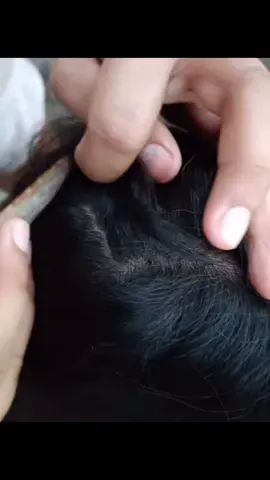 Lice cracking #lice #kuto #liceremoval #asmrsounds #StressRelief #viralvideo 