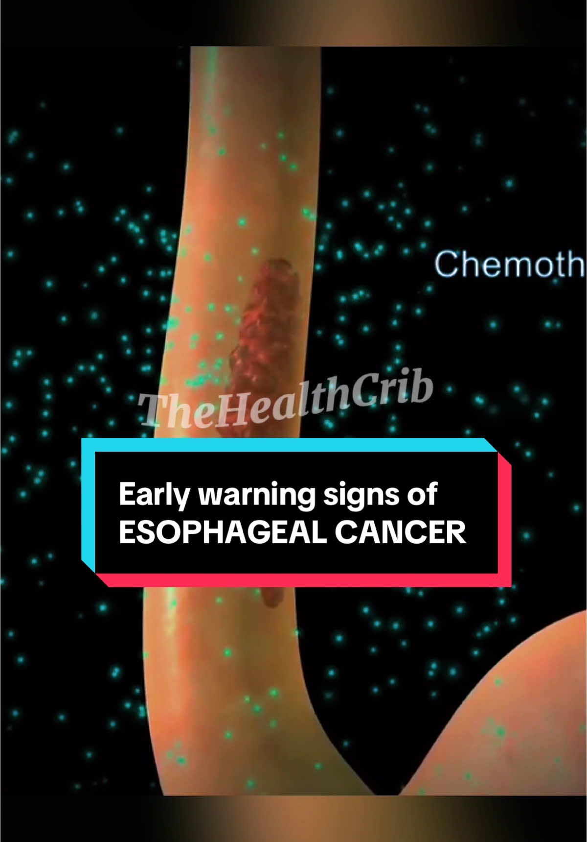 Early warning signs of ESOPHAGEAL CANCER 