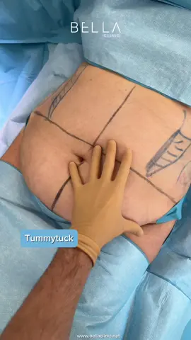 Tummytuck results ger rid of the extra weight and get your dream body😍 Book your consultation with us 👌 #tiktok #bellaclinic #istanbul #turkey ##viral #surgery #tummytuck 