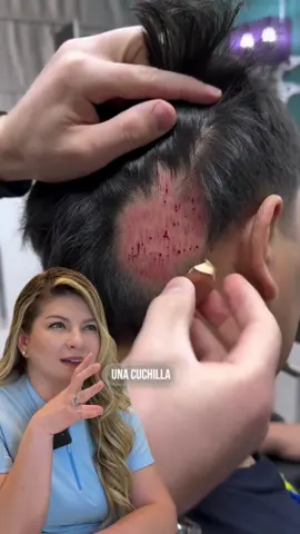 ¿Sabías que la alopecia areata es una condición inflamatoria y autoinmune? 💡 En muchos casos, lo que parece un tratamiento prometedor puede causar más daño que beneficio. 👇 ❌ El procedimiento que se está realizando podría generar dolor, infecciones e irritación. ❌ No habrá cambios reales en el tratamiento de la alopecia areata. ✨ Es importante tener en cuenta que algunos procedimientos no son adecuados y pueden empeorar la situación. Siempre es mejor consultar a un especialista antes de probar tratamientos no comprobados. Soy la doctora Laura Ramos, y estoy aquí para ayudarte con información confiable y soluciones efectivas. 💙 #AlopeciaAreata #TratamientosAdecuados #CuidadoCapilar #SaludCapilar #Autoinmune #Alopecia #Dermatología #TratamientosSeguros #ConsejosDeSalud
