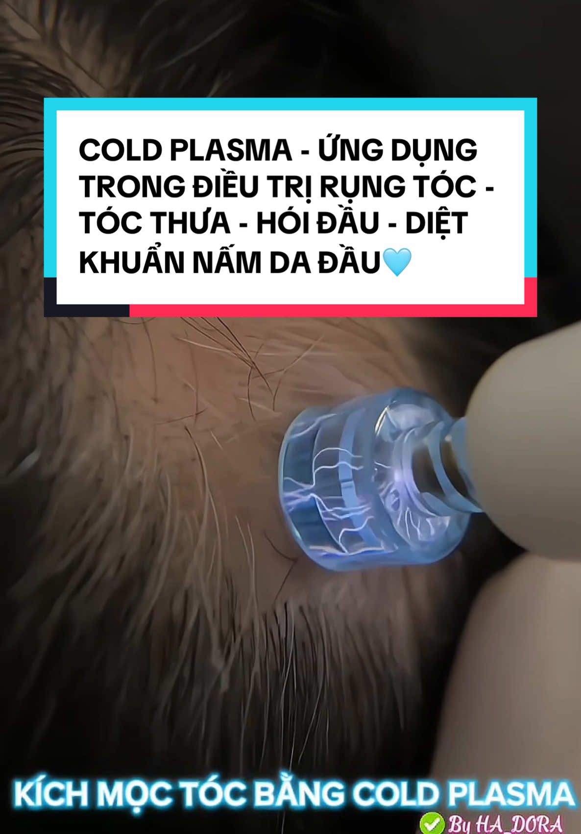 COLD PLASMA - ỨNG DỤNG TRONG ĐIỀU TRỊ RỤNG TÓC - TÓC THƯA - HÓI ĐẦU - DIỆT KHUẨN NẤM DA ĐẦU CỰC KÌ HIỆU QUẢ🩵🩵🩵 #coldplasma #plasma #kichmoctoc #kichmoctocnhanh