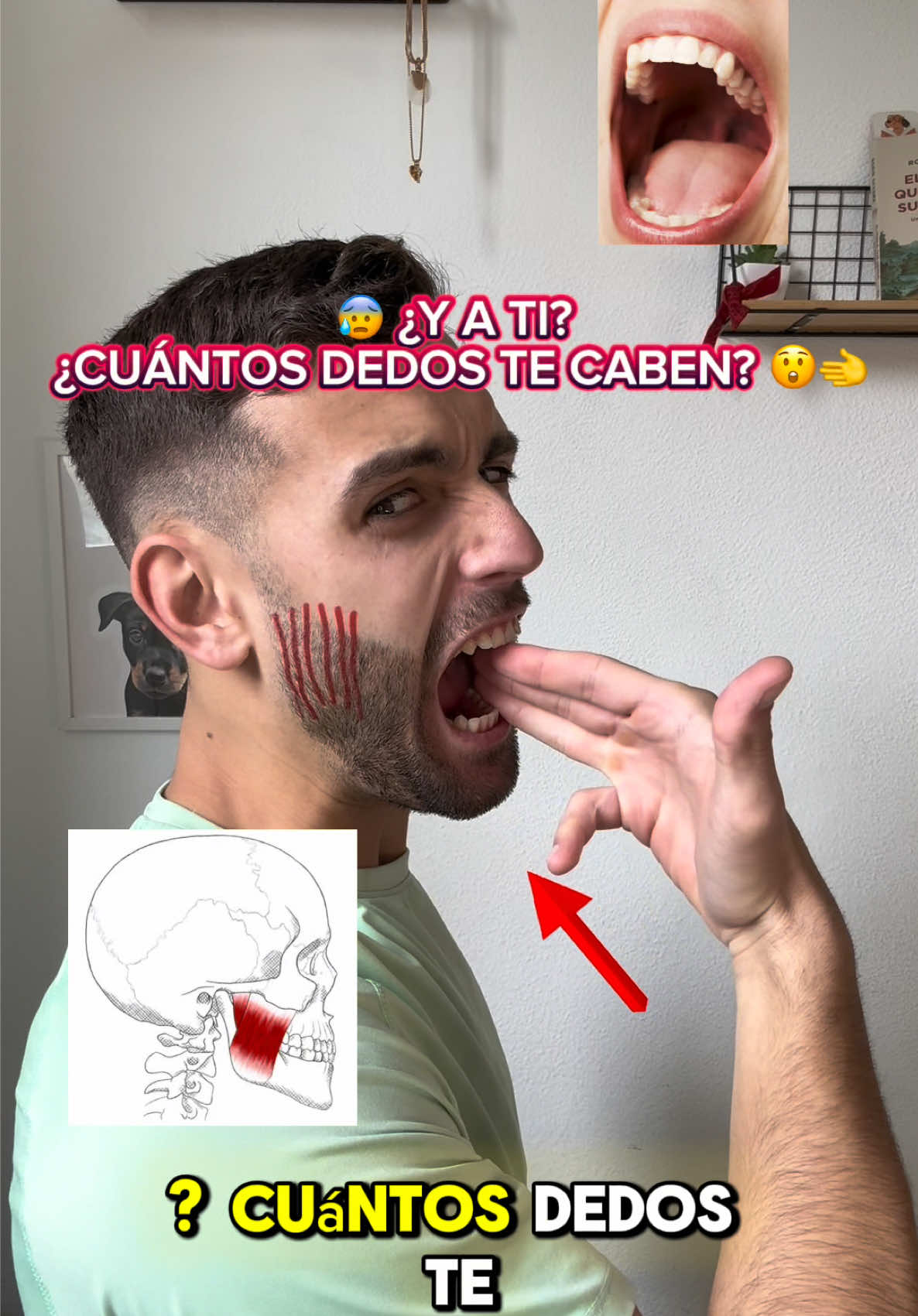 😰 ¿Y A TI? ¿CUÁNTOS DEDOS TE CABEN? 😮🫲 🙌 Si te caben 4️⃣ enhorabuena. 🥳 😔 Si te caben 2️⃣ o 3️⃣ , cuidado ⚠️, quiere decir que tu masetero está contracturado. 💀 ❌ NO normalices vivir con dolor, si has sufrido esta u otra lesión, contáctame. 📱 #bruxismo #masetero #mandibula #masajefacial #dolormandibula #asimetriafacial #facial #adrifisiofitness 