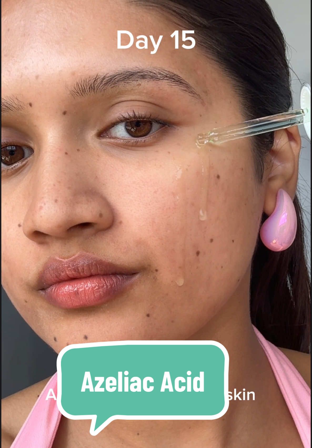 Okay but why is this actually working?? @anua_global @anua_us Azelaic Acid update: My skin is kinda loving this 👀✨  #anua #anuaazelaicacidserum #azelaicacid #redness #rosacea #perioraldermatitis #acnemarks #skincareforrosacea #Koreanskincare #koreanskincare101 #acnejourney #acneprone #acneproneskin #acneskin 