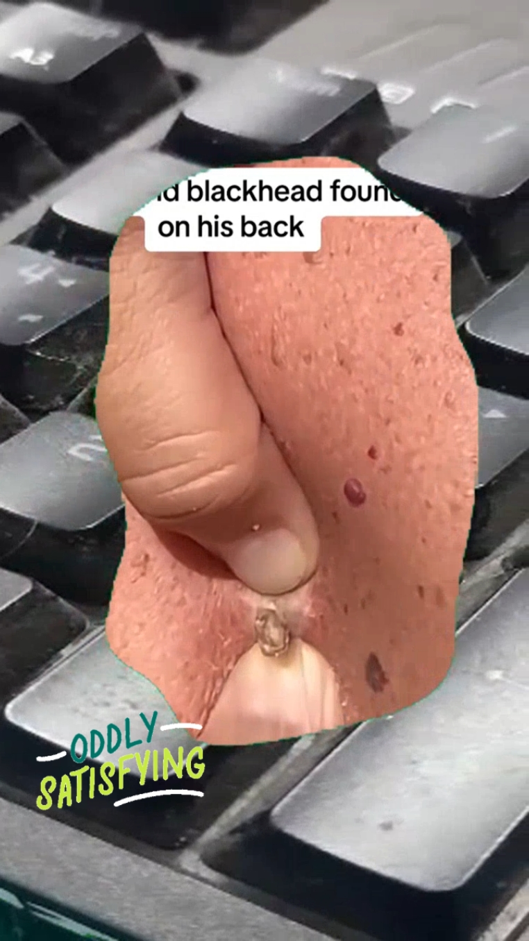 #pimplepop #pimples #pimplepopper #pimpleremover #pimplepopperaddict #pimplepopper2021 #pimpleremoval #pimplepopper2022 #pimples_brufoli #pimple #extractions #extractionsatisfaciton #extractionslovers #extractionsatisfaction #extractionsfacial #extractionstok #extractionsatisfaction🤗 #extractionshooter #extractionslover #extractionsfacialextraction #satisfyingvideos #satisfyingsounds #satisfyingsound #satisfyingcleans #satisfyingasmr #satisfyingart #satisfyingcleaning #satisfyinglips #satisfyingvideo #satisfying#acneskin #acnefighter #acneproneskin #acnescars #acnejourney #acneskincare #acnepatch #acneremoval #acnetreatment #acne #blackhead #blackheads #blackheadsremoval #blackheadsss #blackheadsremover #blackheadsremovalmask #blackheadsextractions #blackheadspopping #blackheadstrip #blackheadsout 