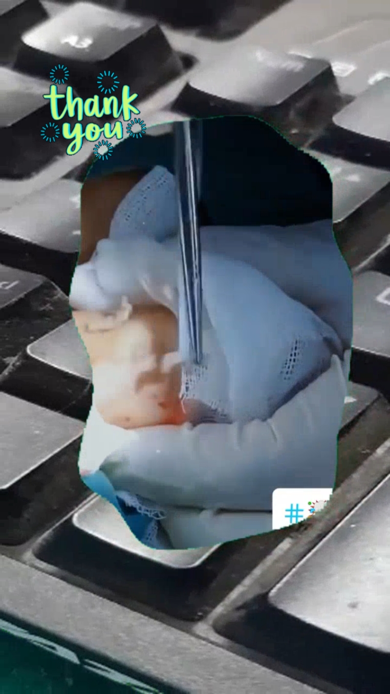 #pimplepop #pimples #pimplepopper #pimpleremover #pimplepopperaddict #pimplepopper2021 #pimpleremoval #pimplepopper2022 #pimples_brufoli #pimple #extractions #extractionsatisfaciton #extractionslovers #extractionsatisfaction #extractionsfacial #extractionstok #extractionsatisfaction🤗 #extractionshooter #extractionslover #extractionsfacialextraction #satisfyingvideos #satisfyingsounds #satisfyingsound #satisfyingcleans #satisfyingasmr #satisfyingart #satisfyingcleaning #satisfyinglips #satisfyingvideo #satisfying#acneskin #acnefighter #acneproneskin #acnescars #acnejourney #acneskincare #acnepatch #acneremoval #acnetreatment #acne #blackhead #blackheads #blackheadsremoval #blackheadsss #blackheadsremover #blackheadsremovalmask #blackheadsextractions #blackheadspopping #blackheadstrip #blackheadsout 