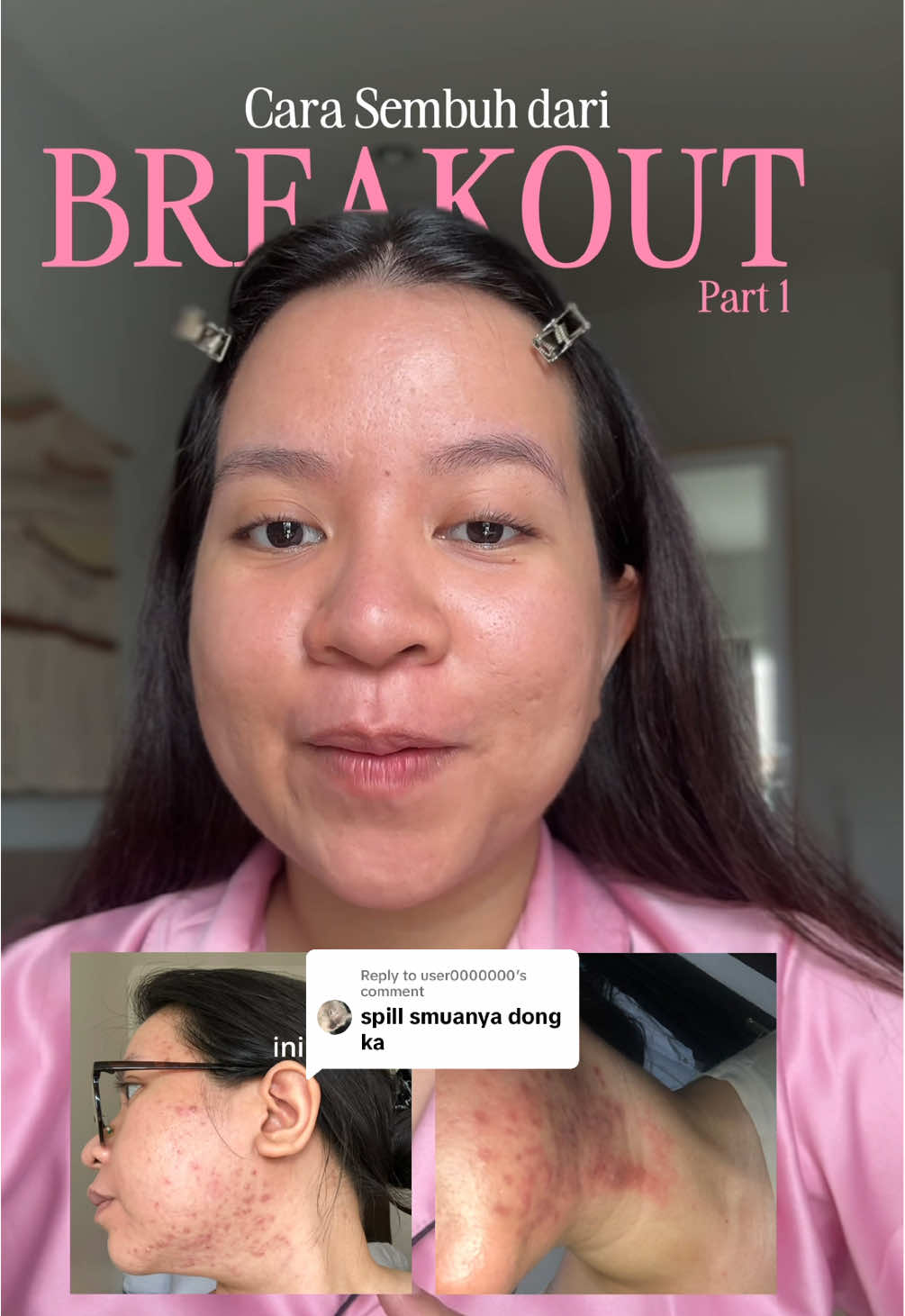 Replying to @user0000000 Cara sembuh dari BREAKOUT Part 1 (non-skincare) as an acne prone skin girl 💖🫶 #acnesurvivor #acnesurvivorighter #GlowUp #acneproneskin #oilyskin #acnetips #acnetips #acnemakeup #acne #acnefighter #glowupjourney 
