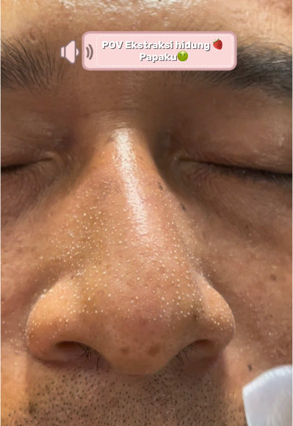 gacorr kalo buat bersiin komedo ini!! 🤩 #komedo #blackhead #focalskin #blackheadsremoval #nosepatch 