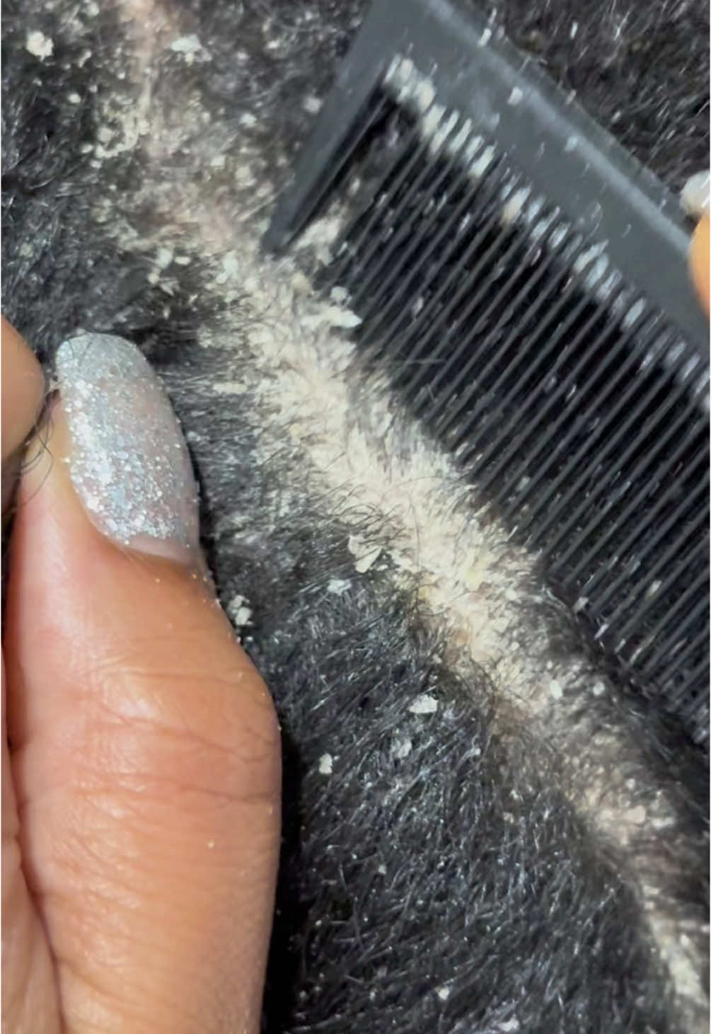 ❄️ ❄️❄️❄️ … #Dandruff #scratching #flakes #asmr #abcxyz #fyp #scalp #Psoriasis 