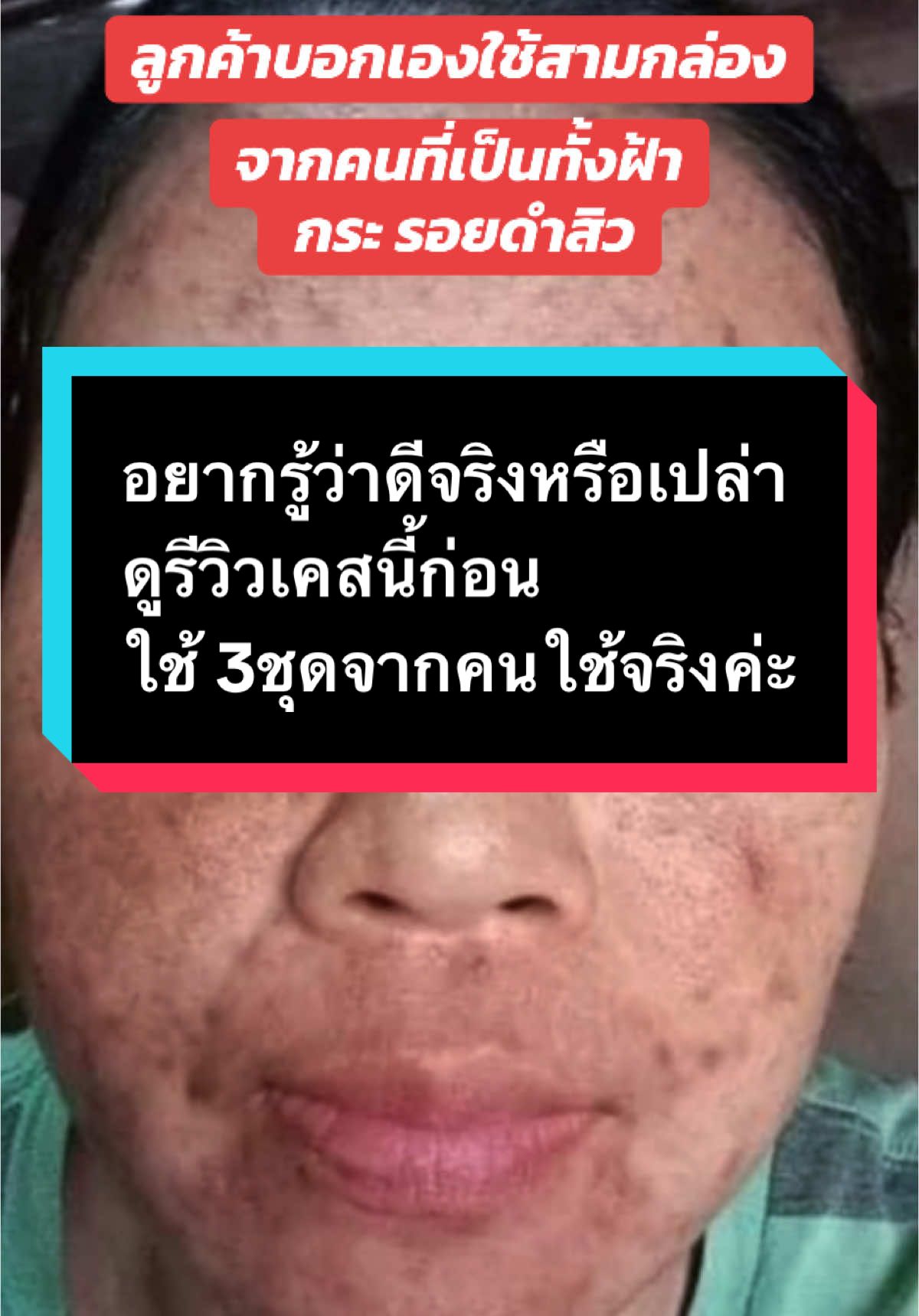 #ครีมปราบฝ้า #ครีมหน้าใส #ฝ้ากระจุดด่างดํา #แนะนําตัวนี้เลยค่ะ #ครีมrcc #ใช้ดีบอกต่อ #ของแท้ต้องมีบัตรตัวแทนเท่านั้น✓ 