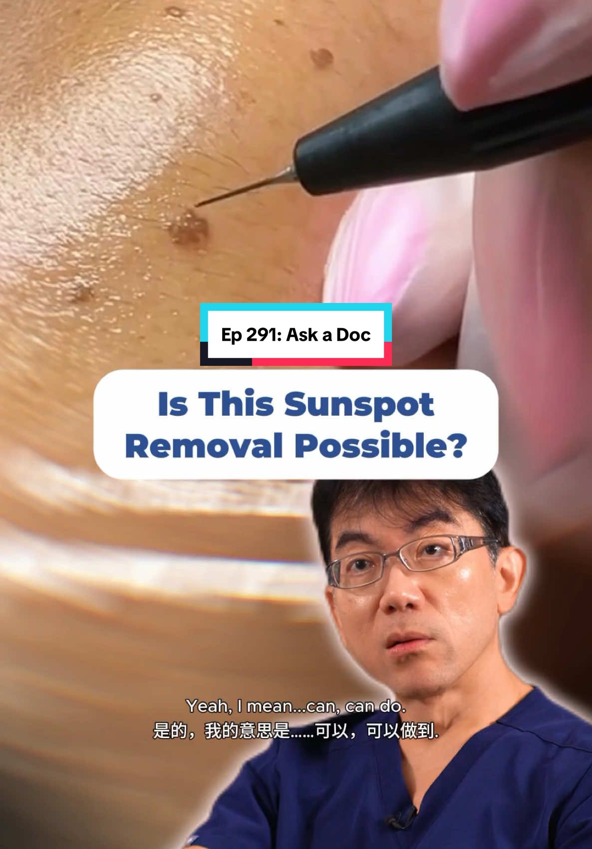Is this sunspot removal possible and are they safe? 🤔 Dr. Lennard reacts to a pigmentation removal done using cautery—breaking down the risks, effectiveness, and what you should know before trying it. Watch to find out the right way to treat sunspots safely!  #tiktoksg #sgtiktok #skincaretiktok #doctorsoftiktok #medicaltiktok #skintok #pigmentation #skintreatment #melasma #melasmamanagement #pigmentationtreatment #healthyskin #collagen #skinrejuvenation #hyperpigmentation #skincare  #hydroquinone #inflammation #skinhealth #evenskintone #chronic #chronicskin #skinexpert #glowyskin #skinrepair #skindeepcare #skinhealing #lasertreatment #erbiumlaser #picolaser #co2laser #freckles #sunspot #agespot #cysteamine #melasmatreatment #skintransformation  #medicalaesthetic #glowingskin #ensoulmedicalclinic #ensoulmedical #ensoulclinic #medical #aesthetic #laser #laserclinic #singapore #clinic #sgclinic #skinhealth #sgfyp #fypsg #singapore #sg #aestheticclinic #aestheticclinicsingapore #skintips #SkinCare101 #skincaretips #skincareproducts #drlc #drlennard #drlennardchan #pigmentationlaser #laserskin #sunspot #solarlentigo Tel: +65 6836 2833 Whatsapp: +65 8798 2892 Email: info@ensoulclinic.com For more information, visit www.ensoulclinic.com