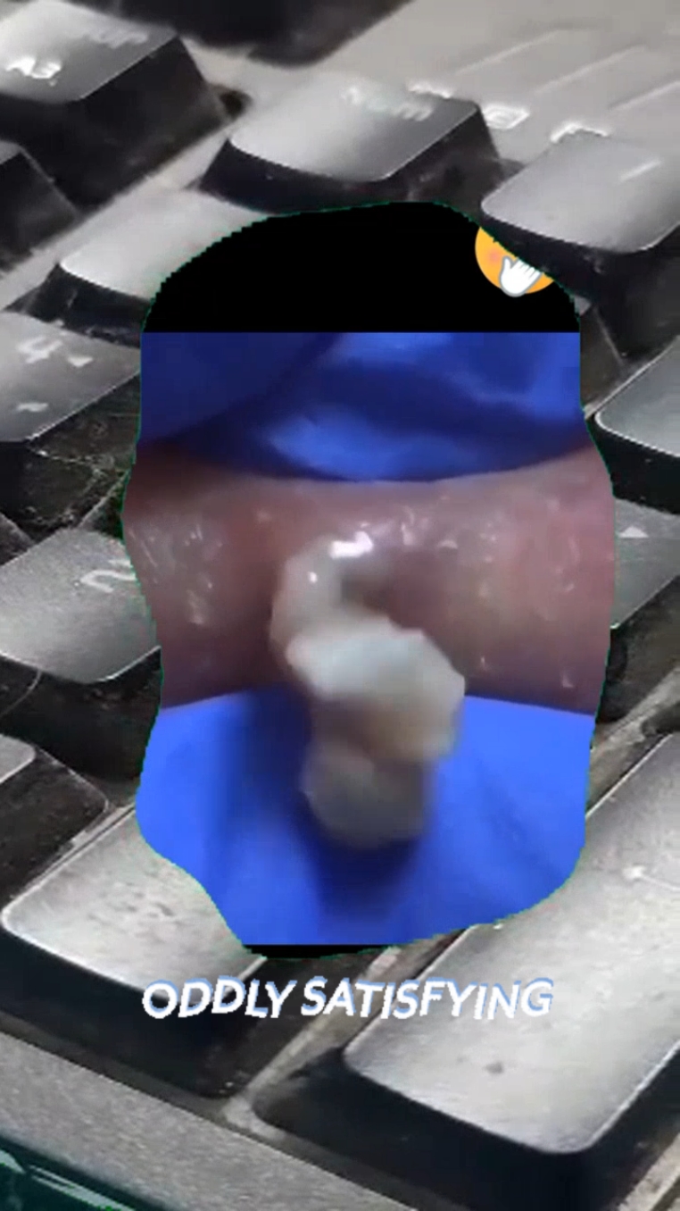 #squeeze #squeezeyuk #pimple #pimplepop #blackhead #satisfyingvideo 