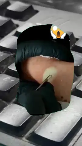 #squeeze #squeezeyuk #pimple #pimplepop #blackhead #satisfyingvideo 