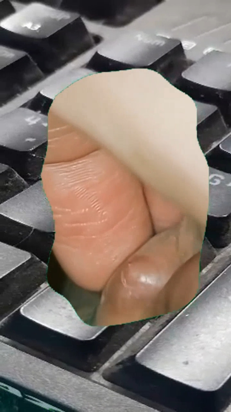 #squeeze #squeezeyuk #pimple #pimplepop #blackhead #satisfyingvideo 