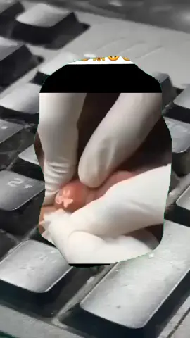 #squeeze #squeezeyuk #pimple #pimplepop #blackhead #satisfyingvideo 