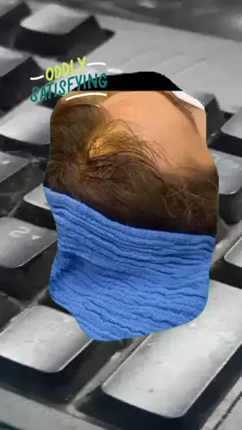 #squeeze #squeezeyuk #pimple #pimplepop #blackhead #satisfyingvideo 
