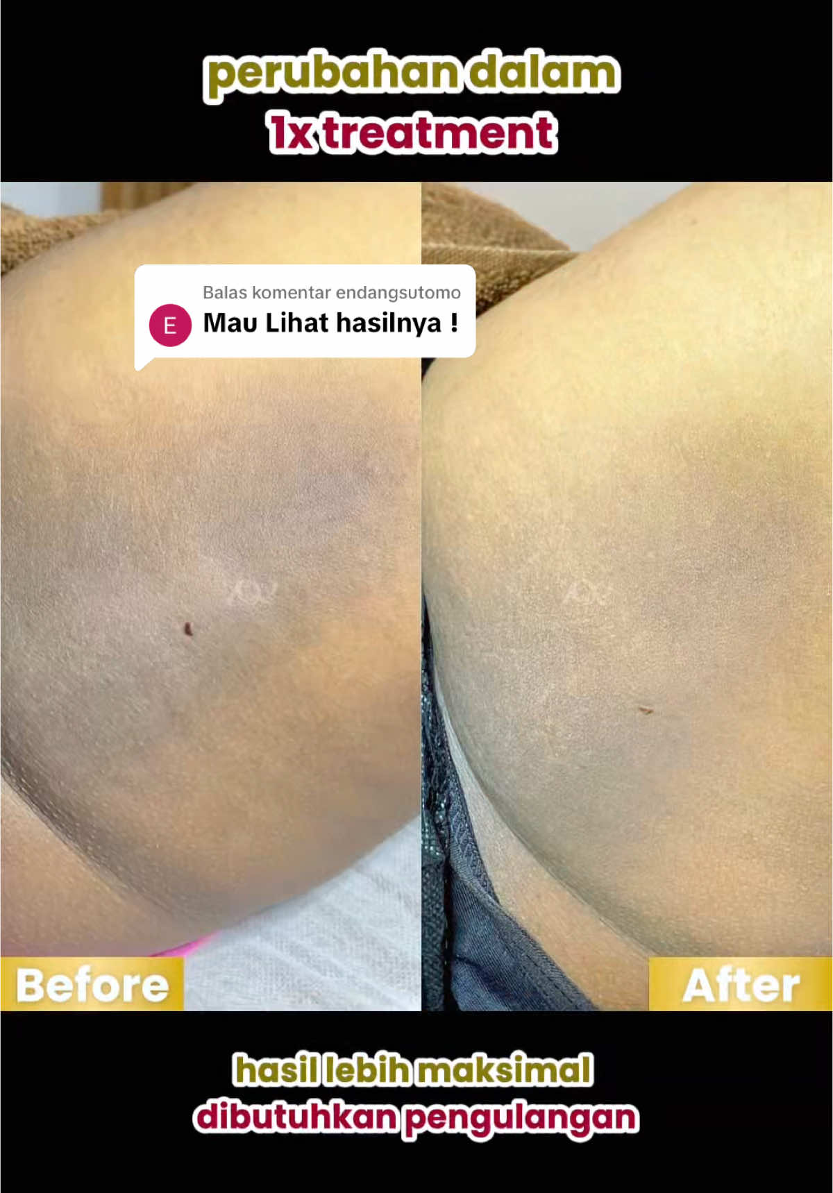 Membalas @endangsutomo 500ribuan selengki auto cerah😱‼️ #brazilian #laser #laserhairremoval #hairremoval #treatment #klinikkecantikansurabaya #fyp #fypシ゚ 