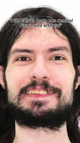 Eai? Será que o William mudou muito? 🤔 Transformação de vida através do sorriso! 💥 #lentesdecontacto #lentes #odontologia #transformation #foruyou #lentesdeporcelana #lentesdeporcelana #fyp 