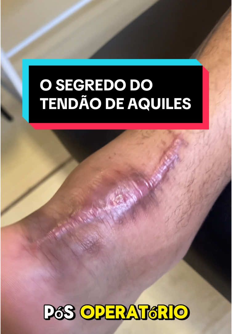 FALA ATLETA! Você sabia que a aderência entre o tendão de Aquiles e a pele pode comprometer sua recuperação pós-operatória? No vídeo de hoje, eu mostro como a **massagem cicatricial** e a **liberação miofascial** na panturrilha e no tibial anterior podem fazer toda a diferença na sua reabilitação! 💪✨   Essas técnicas ajudam a:   ✅ Liberar aderências e melhorar a mobilidade do tendão;   ✅ Reduzir a rigidez e a dor;   ✅ Prevenir complicações e garantir uma recuperação funcional.   Se você está passando por uma recuperação ou conhece alguém que está, esse vídeo é pra você! Vem conferir as dicas e aprender como cuidar da sua cicatriz da forma certa. 🎥👇   #Fisioterapia #Recuperação #TendãoDeAquiles #MassagemCicatricial #LiberaçãoMiofascial #Saúde #Reabilitação