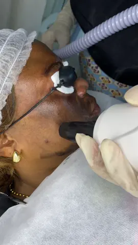 Hollywood Peeling 🤩#estriasembarazo #estriasvermelhas #manchas #lasermedicoesthetique #portugal🇵🇹 #portugal🇵🇹 