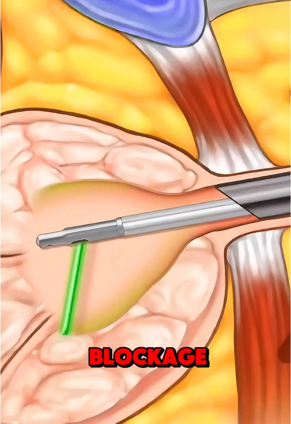 Green Light Laser Therapy (3D Animation) #enlargedprostate #prostateenlargement #prostatesurgery #greenlightlasertherapy #bph #benignprostatichyperplasia #pvp #medical3danimation #3dmedicalanimation 