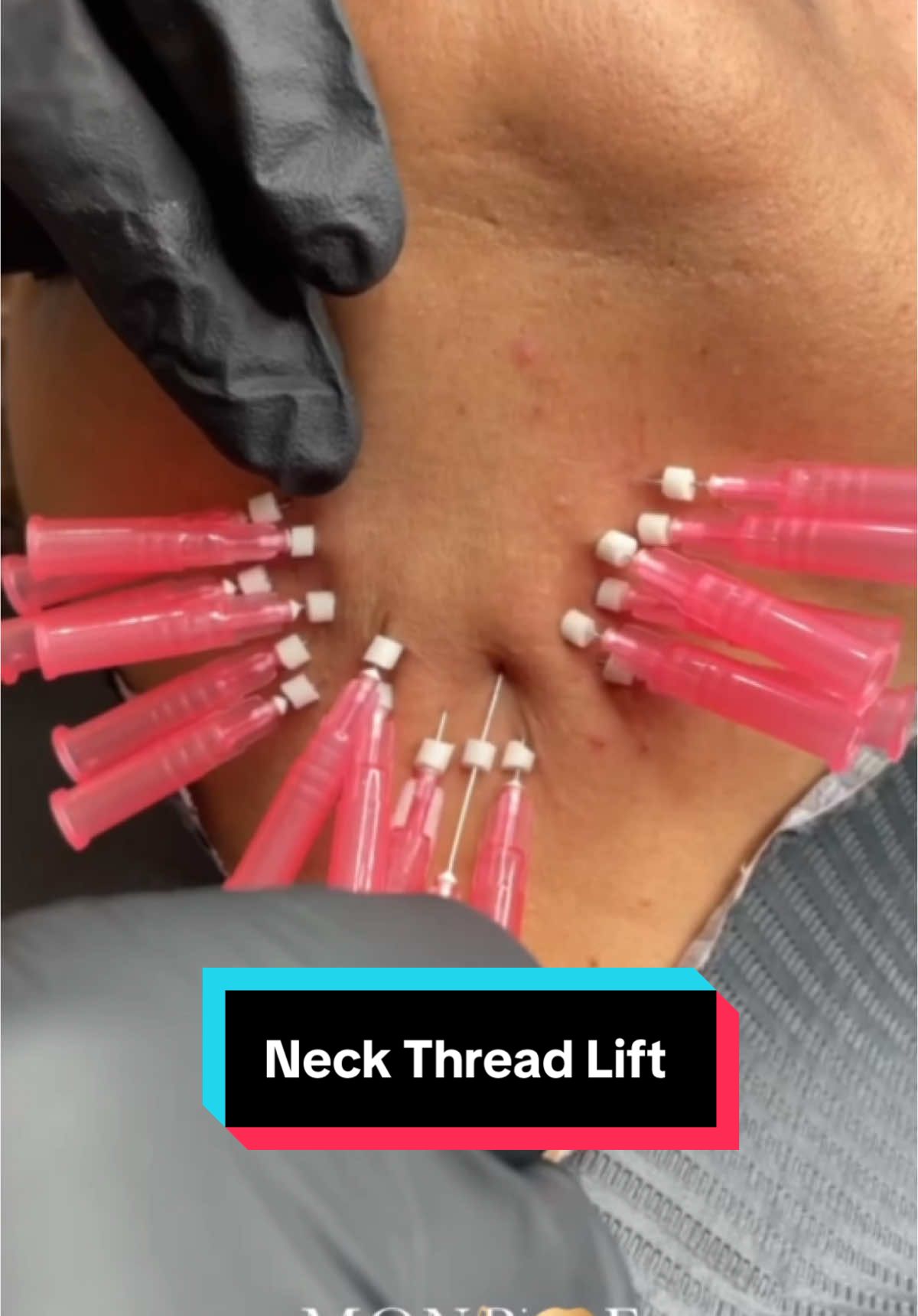 #necklift #facelift #threadlift #pdothreads #threadlift #pdothreadlift 