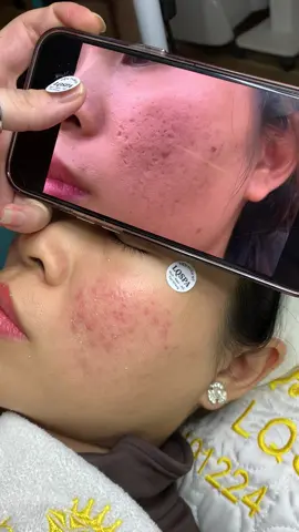 Cập nhật Sẹo#chamsocdamun#chamsocdaseo#chamsocdanam#tanbinh#govap #Lequynh #quynhle#lqspa #hocnghespa  #chamsocda #lequynhspa #vienthammylqspa#lqspabeautyacdemy 