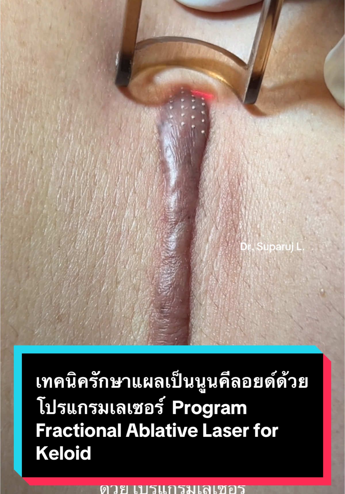 เทคนิครักษาแผลเป็นนูนคีลอยด์ด้วยโปรแกรมเลเซอร์  Program Fractional Ablative Laser for Keloid Treatment  เทคนิคการดูแลรักษาแผลเป็นนูนคีลอยด์  1. Prevention การป้องกันสำคัญที่สุด 2. Early treatment รีบรักษาตั้งแต่แรกได้ผลดีกว่าเช่นทำเลเซอร์หลังหลังตัดไหม หรือหลังเกิดบาดแผลภายในหนึ่งเดือน 3. Combination treatment การใช้การรักษาหลายวิธีร่วมกันเช่นการใช้เลเซอร์สองถึงสามชนิด เช่น โปรแกรม Pulsed dye laser PDL / IPL vascular cut off + Fractional CO 2 Laser / Fractional Picosecond Laser  4. พร้อมกับการใช้ยาทา ยาฉีด + การใช้เลเซอร์เพิ่มการดูดซึมของยา Laser assisted drug delivery LADD #รักษาแผลเป็น #รักษาคีลอยด์ #เลเซอร์แผลเป็น #แผลเป็น โปรแกรม #Picosecondlaser #drsuparuj #หมอรุจชวนคุย #demedclinic #fractionallaser #fractionalco2laser  @Ruj Suparuj 