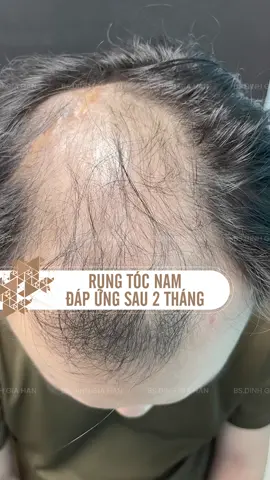 Rụng tóc nam đáp ứng chỉ sau 2 tháng, bạn có tin không? #nguoilamychat #minoxidil #tóc #rungtoc