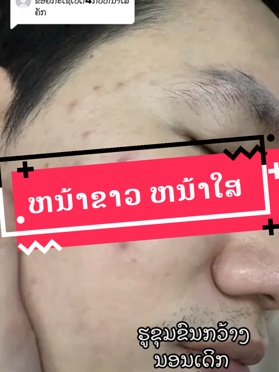 ສູດຫນ້າຂາວ#ຄີມkt #ຄີມເຄທີປາບສິວປາບຝ້າ 