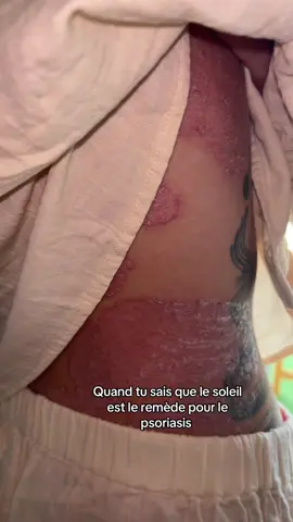 Sous le soleil 🌞 #remede #psoriasis 