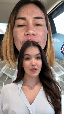 Tips ni Doc para mag lighten ang melasma ng di kailangan gumastos ng malaki!