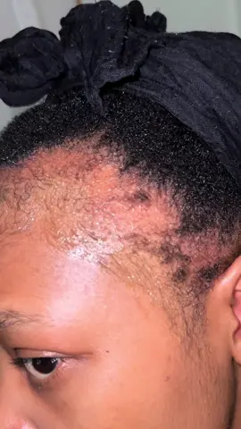 I m loving the results, still working on it though 💁🏽‍♀️ #minoxidil #minoxidilresult #dermaroller 🧪