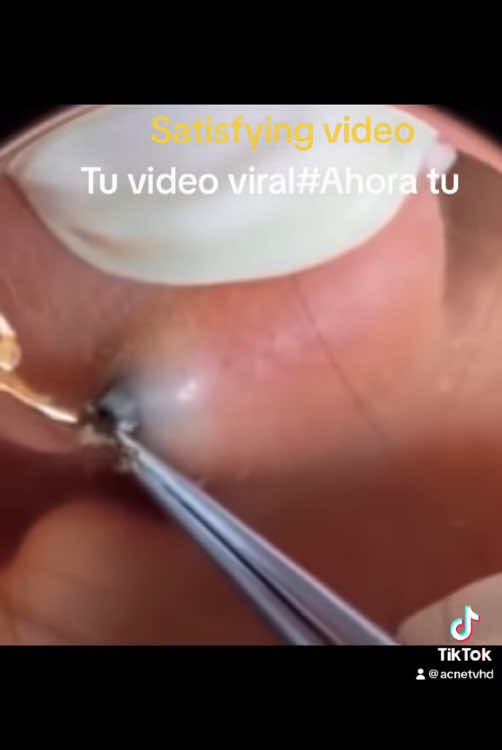 #viraltiktokvideo #blackheadremovals #squeeze #parati #satisfyingvideo 