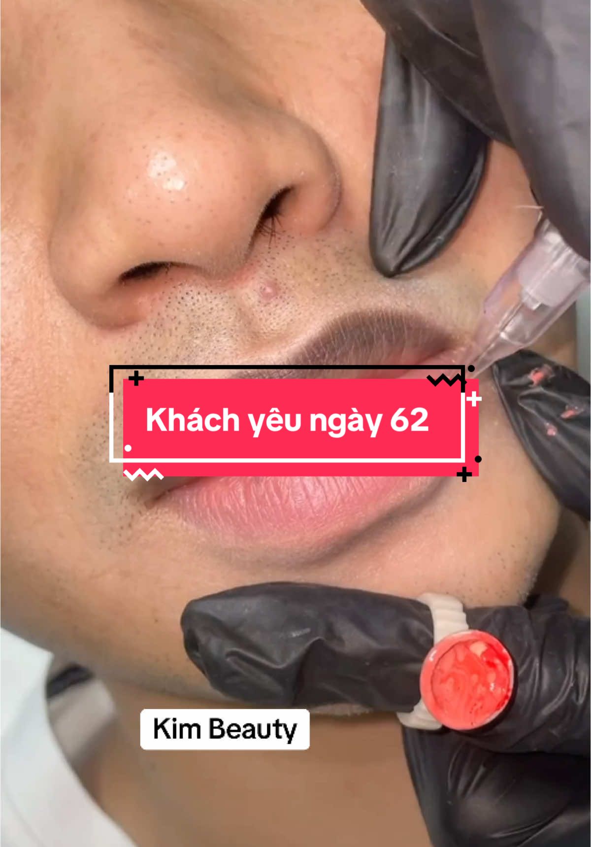 Ca khử thâm môi cho anh khách ở quận 8 #LàmĐẹpPhunMôi #PhunXămThẩmMỹ #kimbeauty #PhunMôi 