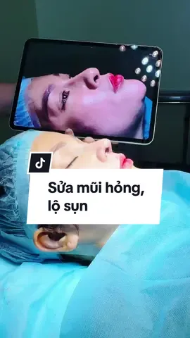 Thêm một case sửa mũi hỏng lộ sụn, vào tay bác sĩ thì “cộng một nàng xinh đẹp rạng ngời” nha nàng ơi ! #nângmũi #phongkhamDuyKhanh #viral #nangmuiDaNang #bacsinangmui