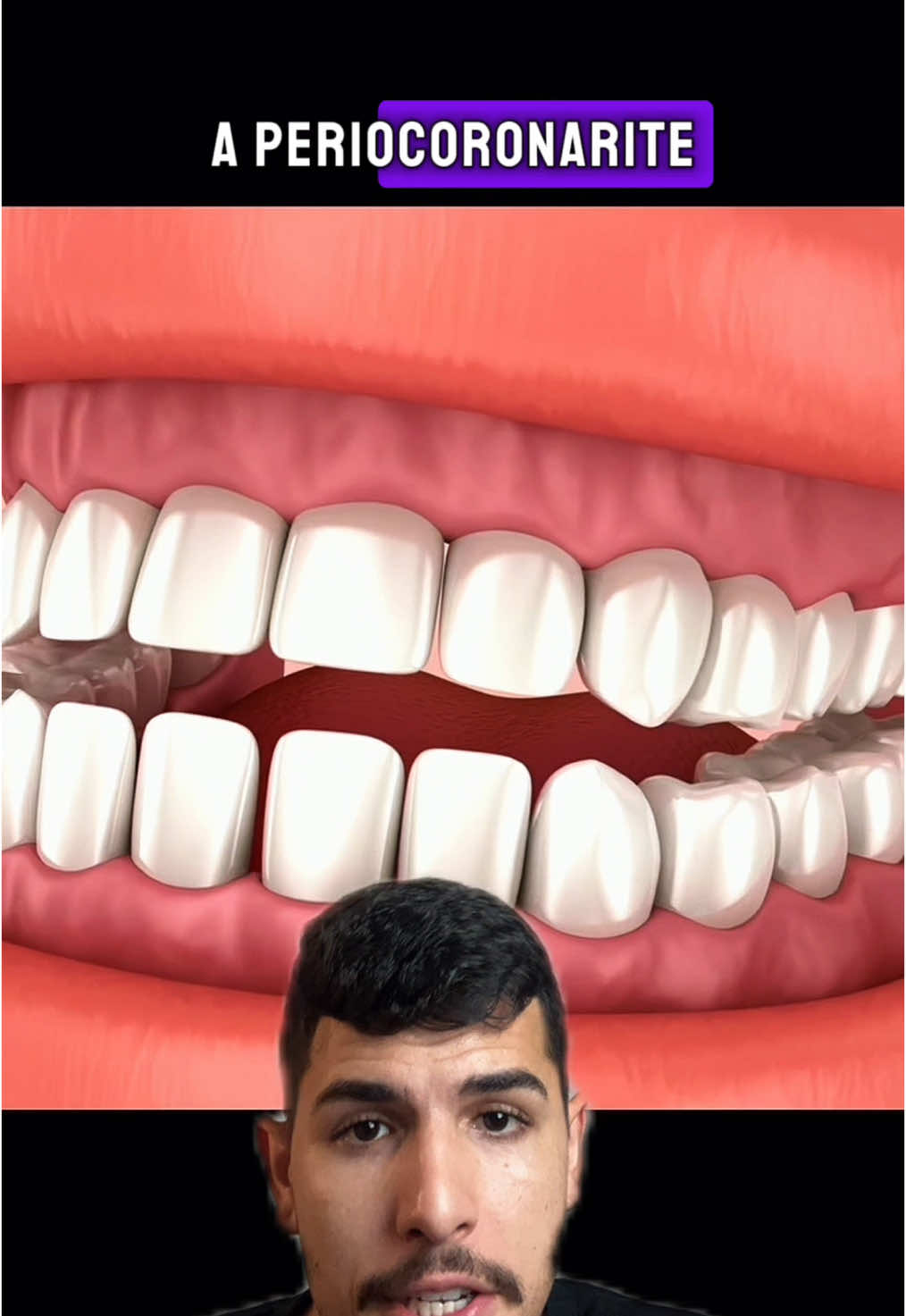 Dor no fundo da boca? Pode ser o siso causando a periocoronarite! Saiba como tratar! #saudebucal #Odontologia #Dentista 