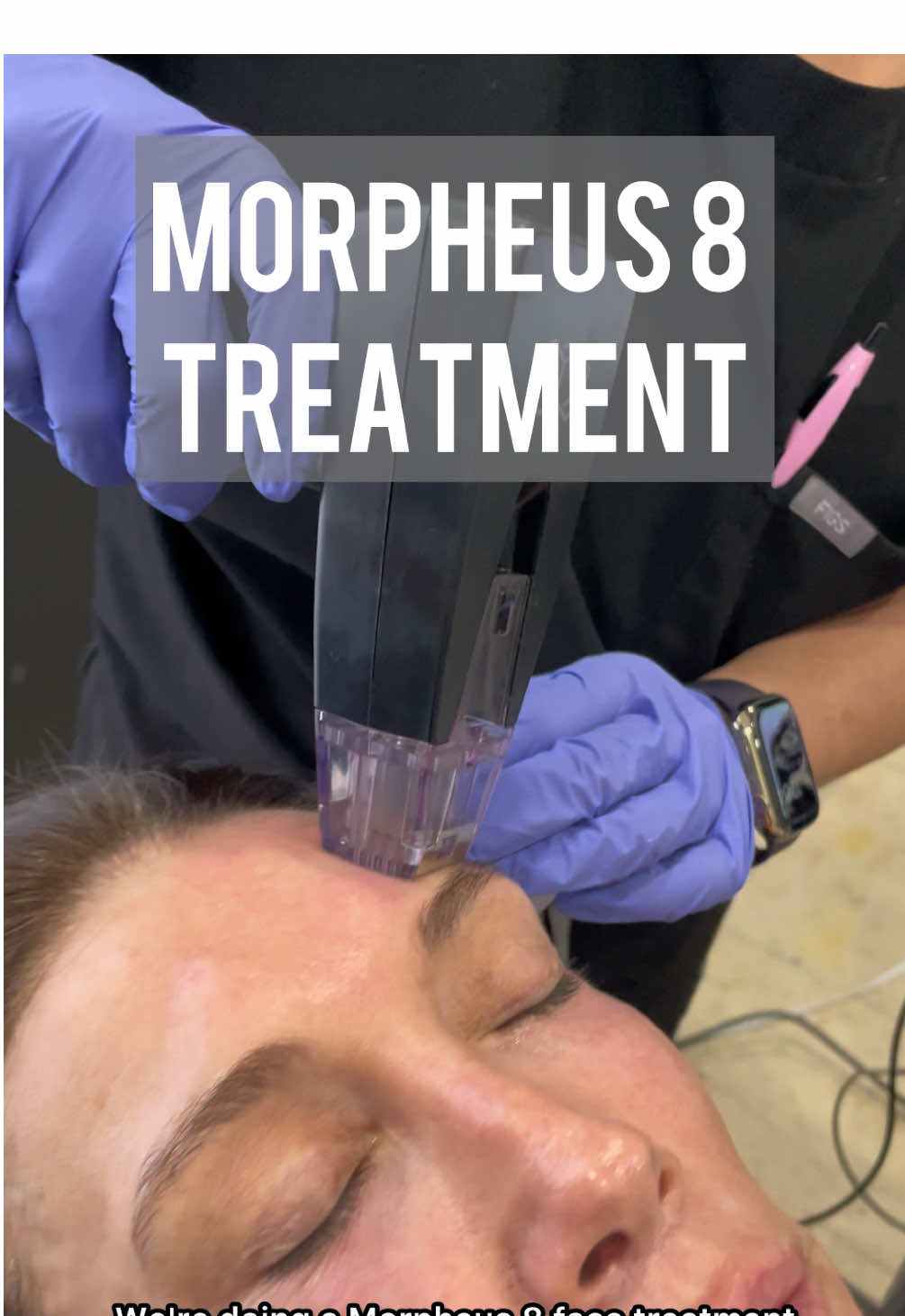 Smooth tighten and glow with Morpheus 8 face treatment  #morpheus #skin #skincare #radiofrequency #microneedling #plasticsurgeonsoftiktok #sarasota 