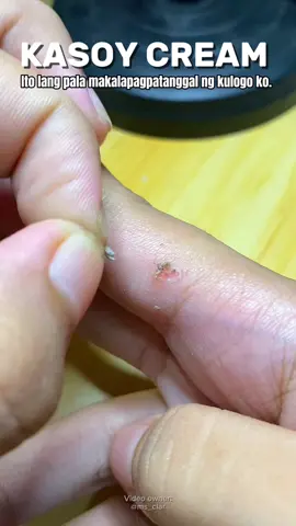 Ang galing ng kasoy cream na to! #moleremoval #wartsremoval #kasoycream #skincare #personalcare 