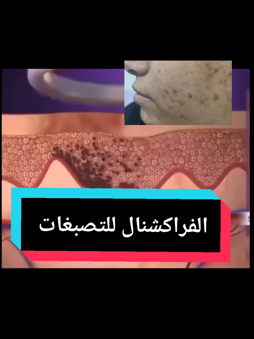الفراكشنال ليزر من أقوى جلسات علاج التصبغات  #د_محمدأشرف_جلديه_وليزر  #فراكشنال_ليزر  #تصبغات_الوجه  #ليزر 