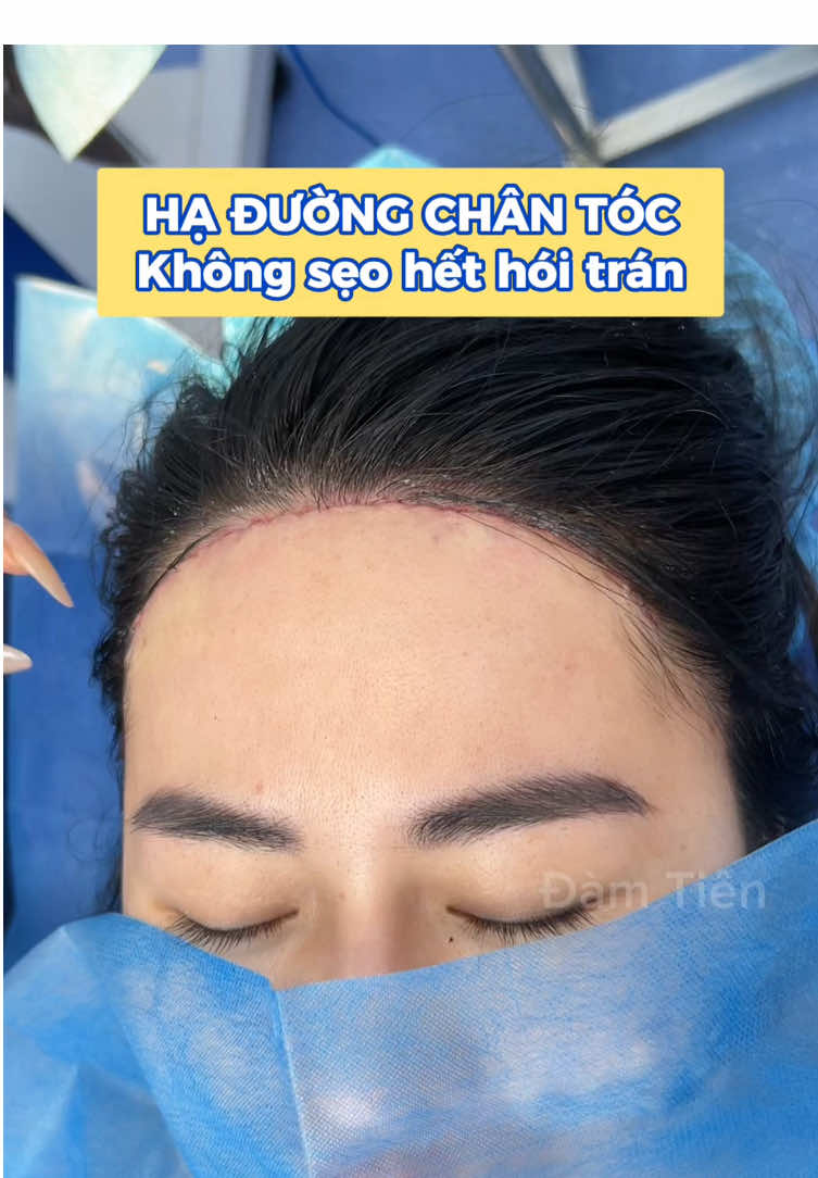 Hạ đường chân tóc cải thiện tỉ lệ khuôn mặt cân đối xinh xắn hơn #damtien #thammy #haduongchantoc 