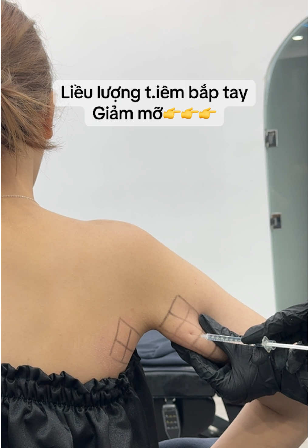 1. Đánh giá trước khi thực hiện ✅ Xác định lượng cơ hoặc mỡ thừa ở vùng bắp tay ✅ Kiểm tra độ săn chắc và độ dày của mô cơ ✅ Xác định vị trí ti.êm phù hợp để đạt hiệu quả tối ưu 2. Công thức ti.êm Botox hỗ trợ làm thon bắp tay ✅ Liều lượng: Dao động từ 50 - 100 units/bên tay, tùy vào độ lớn của bắp tay và mức độ co cơ ✅ Vị trí ti.êm: Xác định cơ triceps brachii (cơ tam đầu bắp tay) Chia thành khoảng 5 - 6 điểm tiêm trải đều trên vùng cơ cần giảm kích thước ✅ Kỹ thuật: Tiêm nông vào lớp cơ, tránh đi quá sâu Giữ khoảng cách đều giữa các điểm ti.êm 3. Công thức t.iêm hỗ trợ thon gọn mỡ bắp tay (Meso) ✅ Hoạt chất thường dùng: Các sản phẩm chuyên biệt giúp hỗ trợ xử lý mỡ thừa ✅ Vị trí ti.êm: Tiêm theo hình lưới để phân bổ đều sản phẩm Chia thành 8 - 10 điểm/bên tay, tùy vào lượng mỡ dư ✅ Độ sâu tiêm: 4 - 6mm, đảm bảo sản phẩm đi vào lớp mỡ dưới da 4. Lưu ý quan trọng ⚠️ Không ti.êm vào vùng có dây thần kinh hoặc mạch máu lớn ⚠️ Kết hợp với massage nhẹ để giúp sản phẩm phân tán đều ⚠️ Duy trì chế độ ăn uống hợp lý và vận động nhẹ nhàng để tăng hiệu quả Nếu muốn tối ưu kết quả, nên kết hợp cả 2 phương pháp Botox & Meso theo chỉ định phù hợp! 💉✨