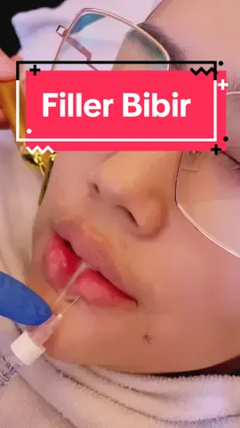 Hi sahabat Novi's Filler bibir adalah prosedur paling populer bagi banyak orang yang berniat untuk memperbesar ukuran bibir Prosedur ini dilakukan dengan cara menyuntikkan zat pengisi yang umum digunakan seperti asam hialuronat ke dalam bibir sehingga dapat meningkatkan ketebalan bibir karna akan menambahkan bentuk struktur, serta volume #novisdermatology #novisclinic #klinikkecantikanbekasi #klinikkecantikanterdekat #promopromo #treatment #fillerlipstick 
