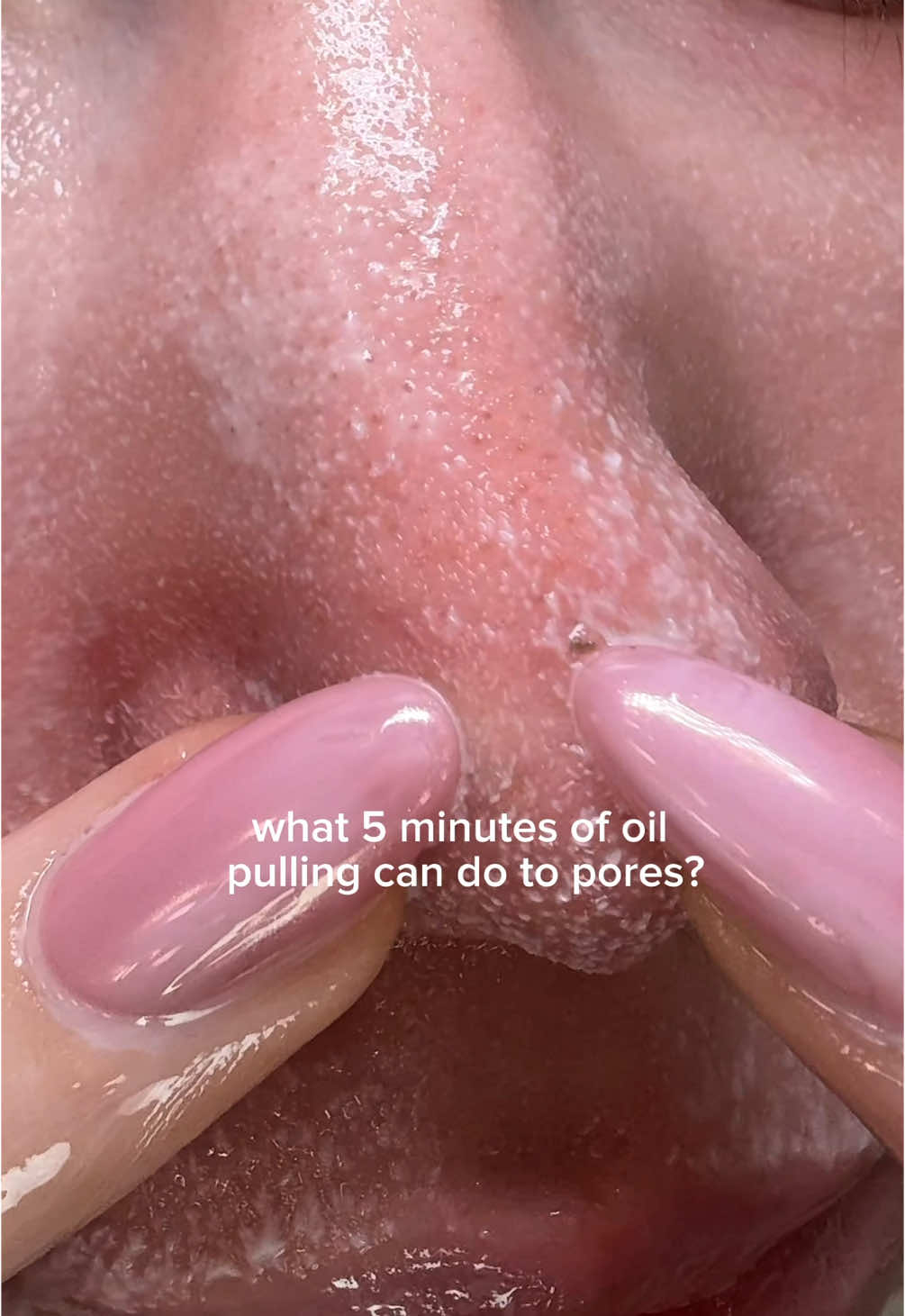 What 5 minutes of oil pulling can do to pores? #koreanskincare #Tiktokmademebuyit #oilcleanser #centella #skin1004 